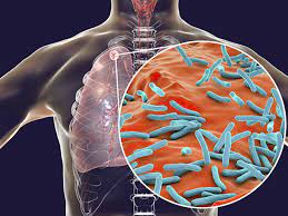 Federal govt warns against Tuberculosis, reveals why it kills silently